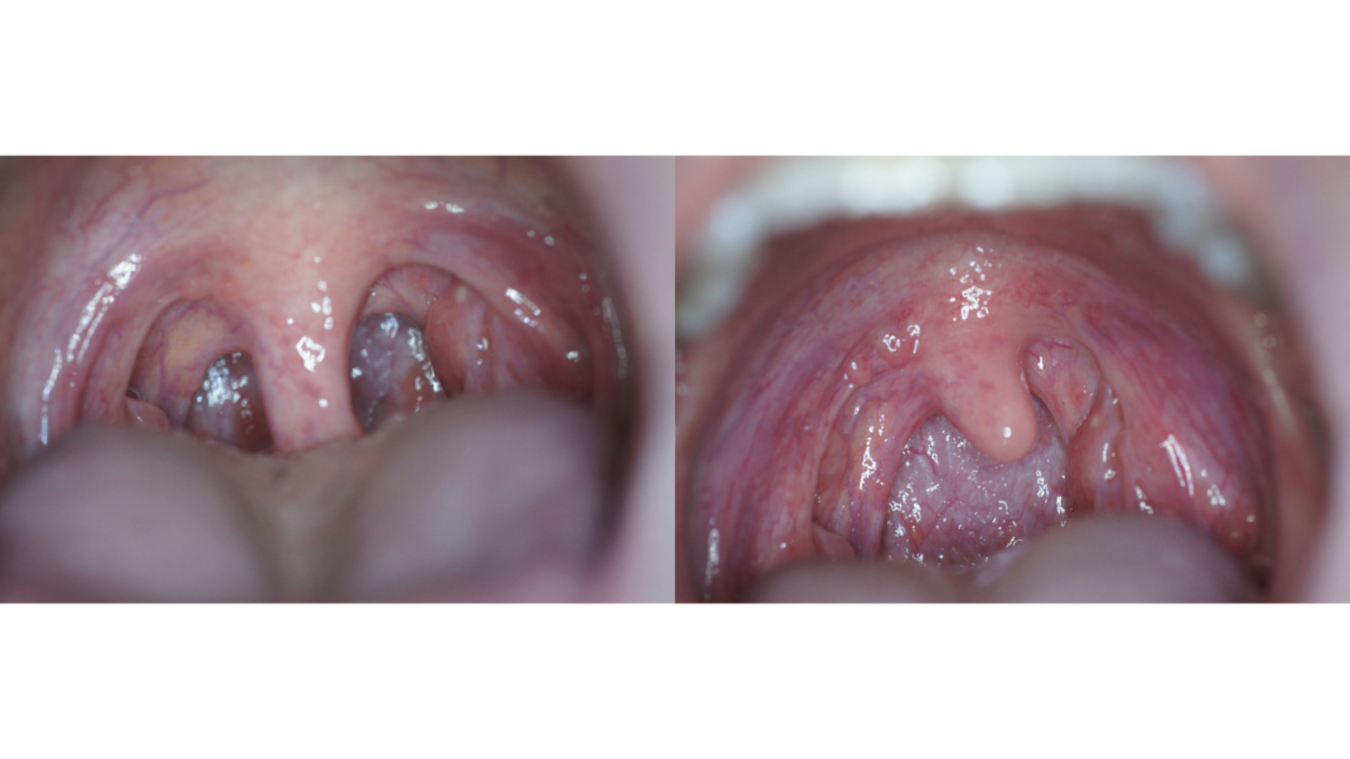 NightLase clinical before and after